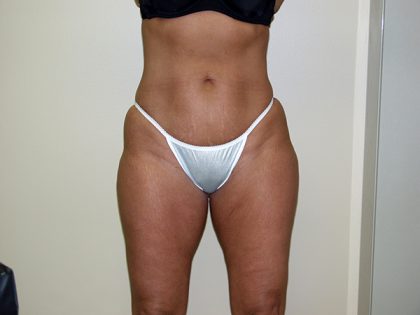 Liposuction Before & After Patient #3817