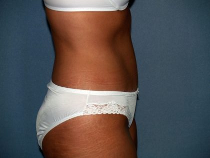 Tummy Tuck Before & After Patient #2151