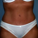 Tummy Tuck Before & After Patient #2151