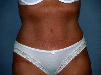 Tummy Tuck Before & After Patient #2151