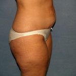 Tummy Tuck Before & After Patient #2151