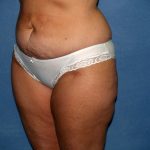 Tummy Tuck Before & After Patient #2151