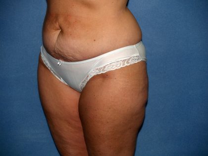 Tummy Tuck Before & After Patient #2151