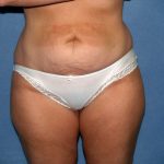 Tummy Tuck Before & After Patient #2151