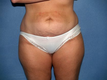 Tummy Tuck Before & After Patient #2151