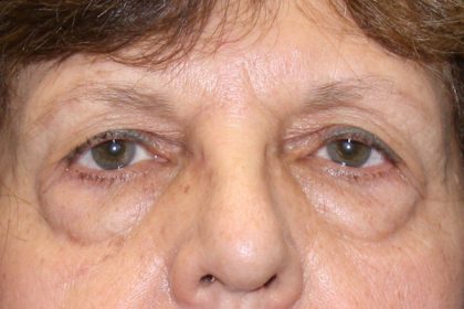 Eye Lid Lift Before & After Patient #4075