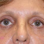 Eye Lid Lift Before & After Patient #4075