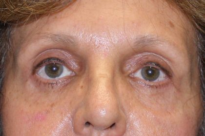 Eye Lid Lift Before & After Patient #4075