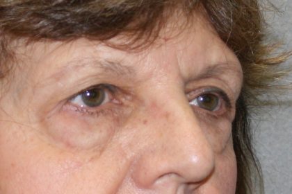 Eye Lid Lift Before & After Patient #4075