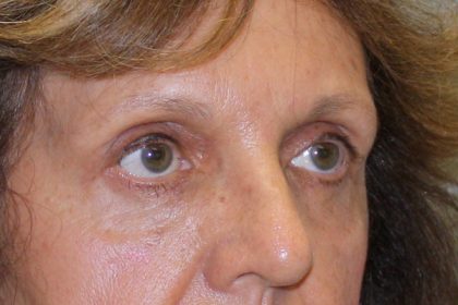 Eye Lid Lift Before & After Patient #4075