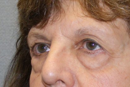 Eye Lid Lift Before & After Patient #4075