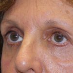 Eye Lid Lift Before & After Patient #4075