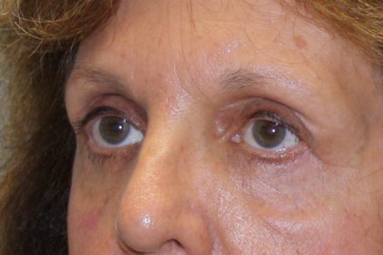 Eye Lid Lift Before & After Patient #4075