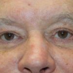 Eye Lid Lift Before & After Patient #5583