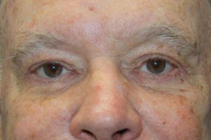 Eye Lid Lift Before & After Patient #5583