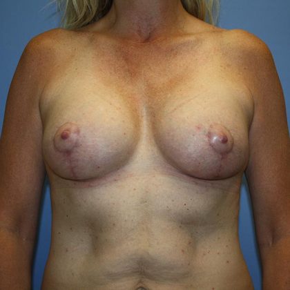 Breast Lift with Implant Before & After Patient #5585