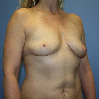 Breast Lift with Implant Before & After Patient #5585