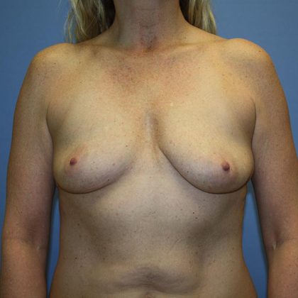 Breast Lift with Implant Before & After Patient #5585