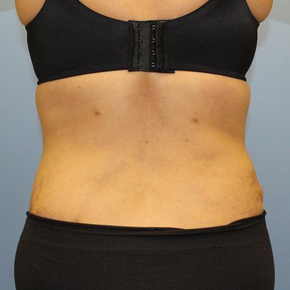 Tummy Tuck Before & After Patient #5591