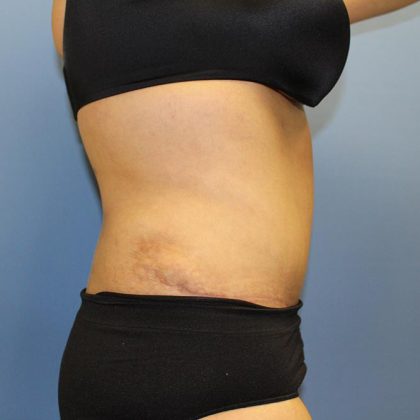 Tummy Tuck Before & After Patient #5591