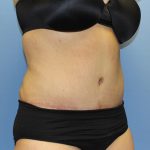 Tummy Tuck Before & After Patient #5591