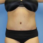 Tummy Tuck Before & After Patient #5591