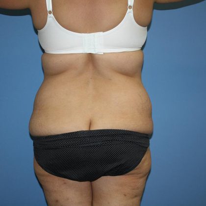 Tummy Tuck Before & After Patient #5591