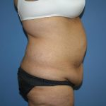 Tummy Tuck Before & After Patient #5591