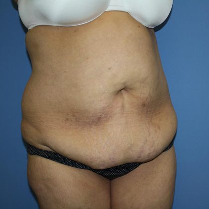 Tummy Tuck Before & After Patient #5591