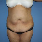 Tummy Tuck Before & After Patient #5591