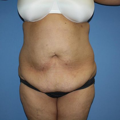 Tummy Tuck Before & After Patient #5591