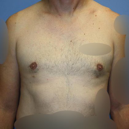 Gynecomastia Before & After Patient #5618