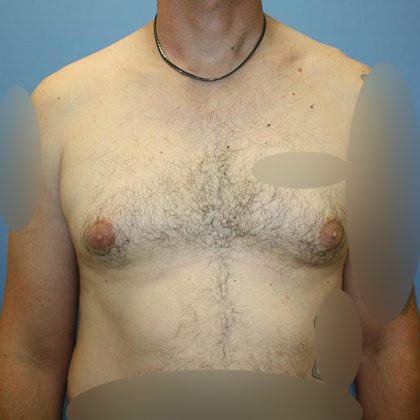 Gynecomastia Before & After Patient #5618