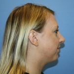 Nose Surgery Before & After Patient #5619