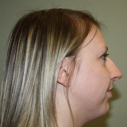 Nose Surgery Before & After Patient #5619