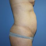 Tummy Tuck Before & After Patient #5661