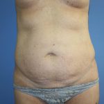 Tummy Tuck Before & After Patient #5661