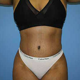 Tummy Tuck Before & After Patient #5665