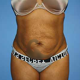 Tummy Tuck Before & After Patient #5665