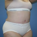 Tummy Tuck Before & After Patient #5667