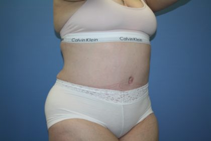 Tummy Tuck Before & After Patient #5667