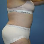 Tummy Tuck Before & After Patient #5667