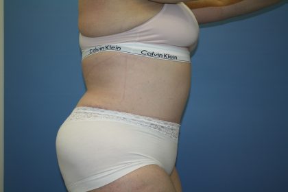 Tummy Tuck Before & After Patient #5667