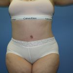 Tummy Tuck Before & After Patient #5667