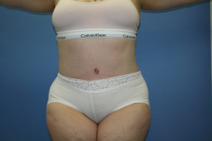 Tummy Tuck Before & After Patient #5667