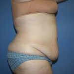 Tummy Tuck Before & After Patient #5667