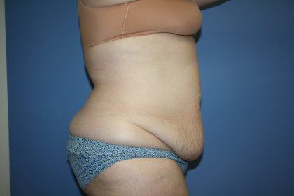 Tummy Tuck Before & After Patient #5667