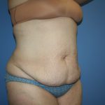 Tummy Tuck Before & After Patient #5667