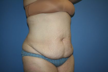 Tummy Tuck Before & After Patient #5667