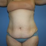 Tummy Tuck Before & After Patient #5667